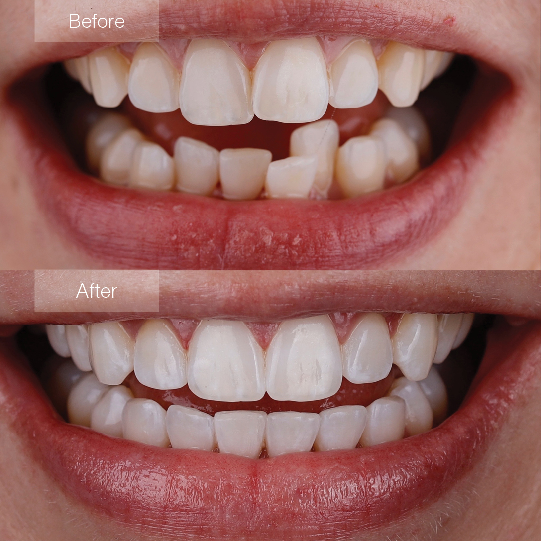 Invisalign Aligners at Dallas Dental Care